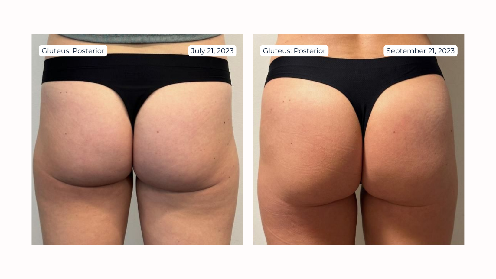 Non-Surgical BBL Practitioner Training Guide and Forms